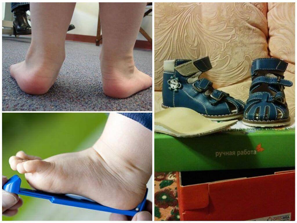 Обувь при деформации стопы у детей