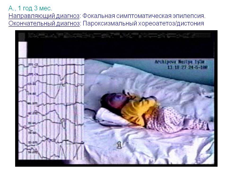Детская эпилепсия: эпидемиология, особенности клинического течения - сибирский медицинский портал