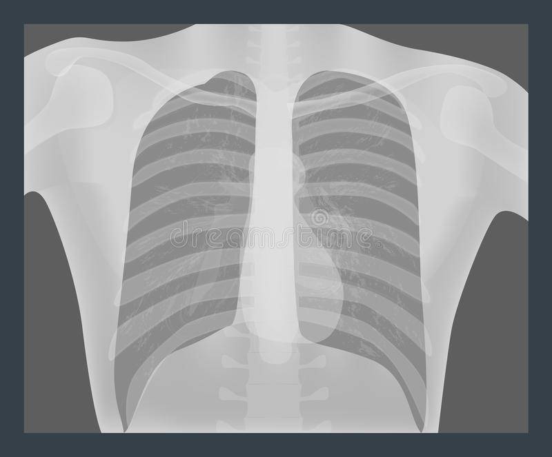Детский рентген лёгких