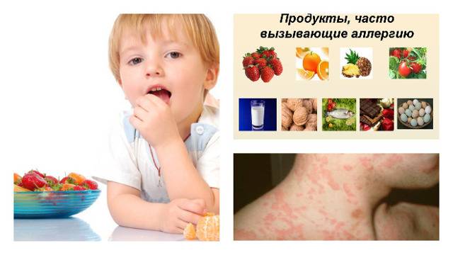 Пищевая аллергия: причины, формы и типичные проявления