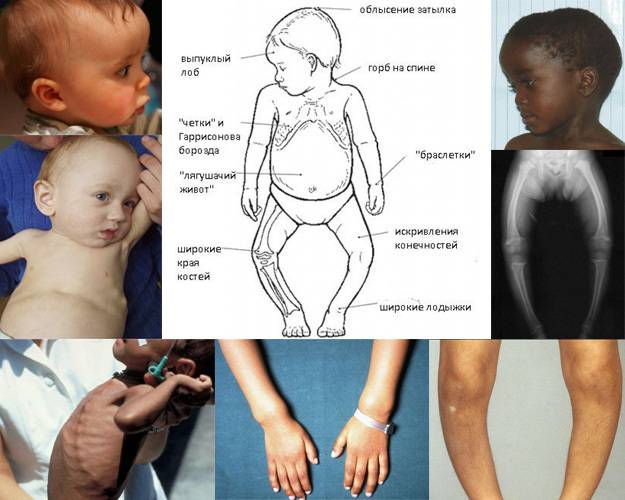 Диагностика и профилактика рахита недоношенных детей