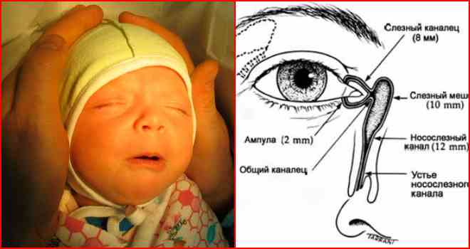 Массаж слезного канала у новорожденных (22 фото): как делать массаж при дакриоцистите новорожденных, массажируем носослезный канал при непроходимости и его закупорке