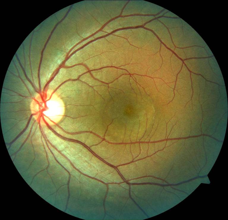 Диабетическая ретинопатия, ее симптоматика и стадии развития