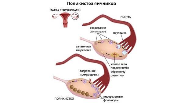 Стимуляция яичников. Стимулирование яичников. Стимуляция яичников для планирования беременности.