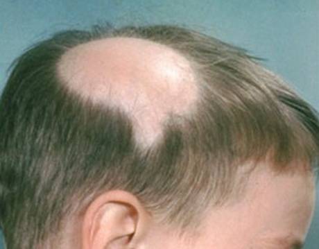 Выпадение волос у детей и подростков: причины, лечение
