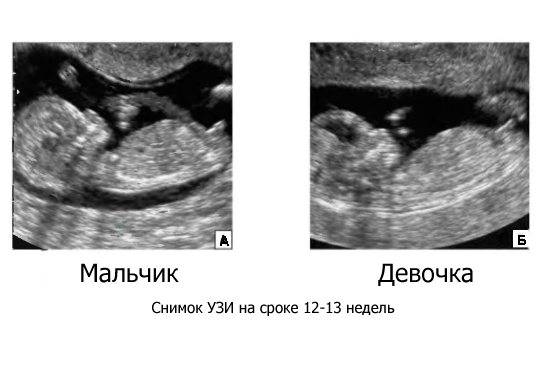 Мальчик или девочка? Определение пола на 12-13 неделе беременности