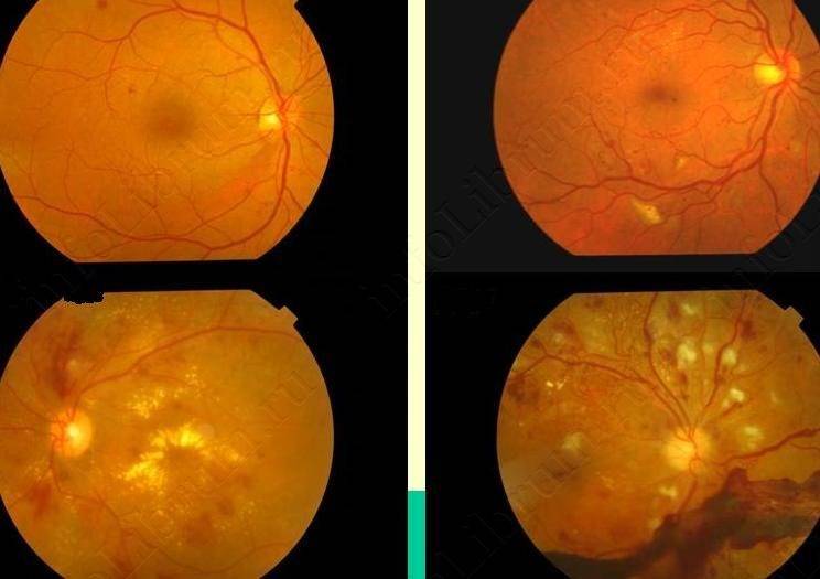 Что такое центральная серозная ретинопатия?