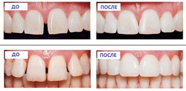 Фторирование зубов у детей и взрослых: цена, отзывы о colgate duraphat