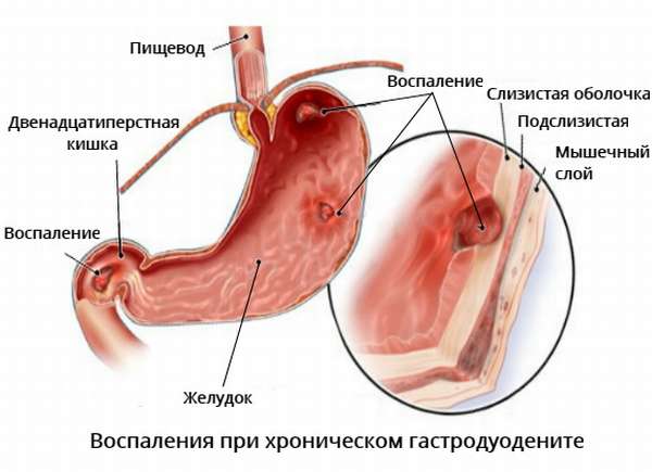 Лечить гастродуоденит в москве | медицинский центр «президент-мед»