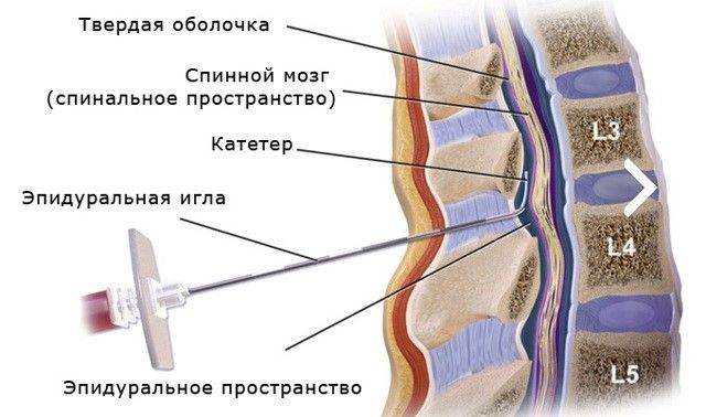 Спина бифида                (spina bifida occulta, скрытое расщепление позвонков, расщелина позвоночника)