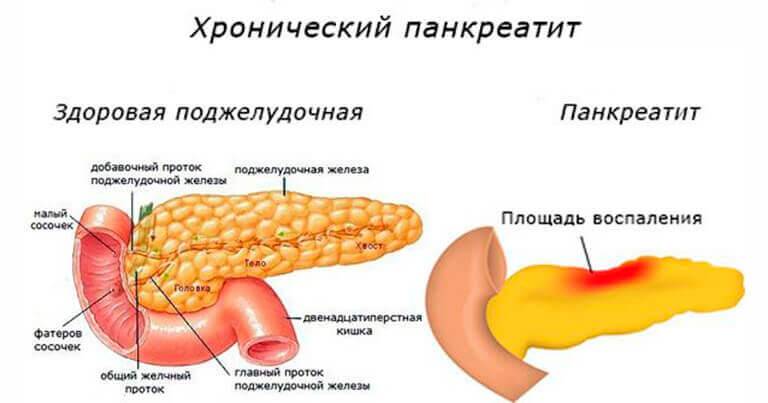 Панкреатит: причины, симптомы, методы диагностики и лечения панкреатита.