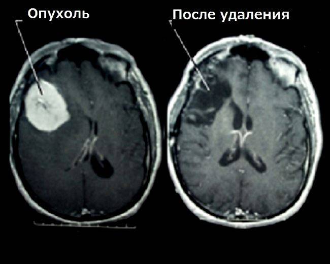 Причина рака головного