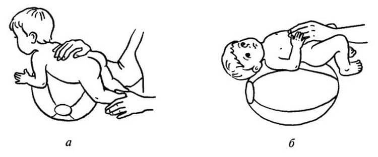 Пупочная грыжа и «щетинка» у новорожденного