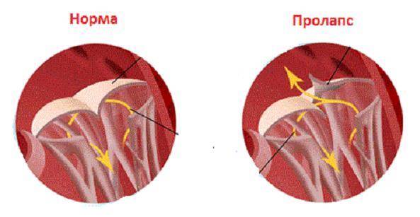 Пролапс митрального клапана сердца, лечение пролапса митрального клапана 1, 2, 3 степени у женщин и мужчин с регургитацией на экг