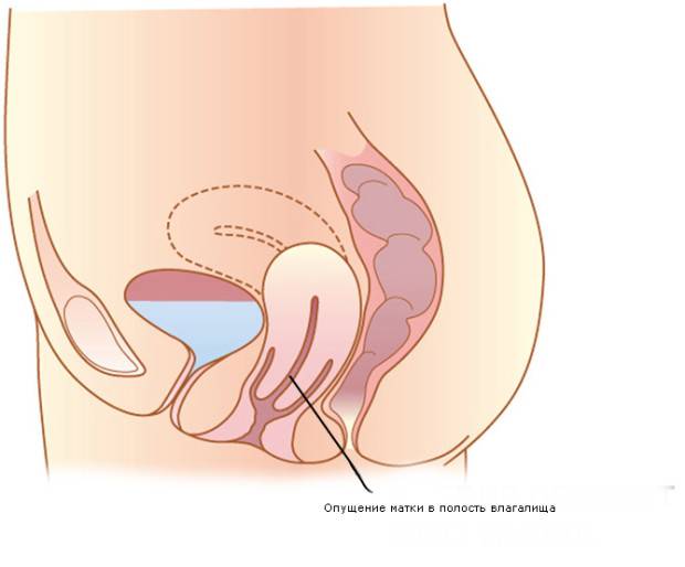 Опущение стенок влагалища и матки: безоперационное и хирургическое лечение