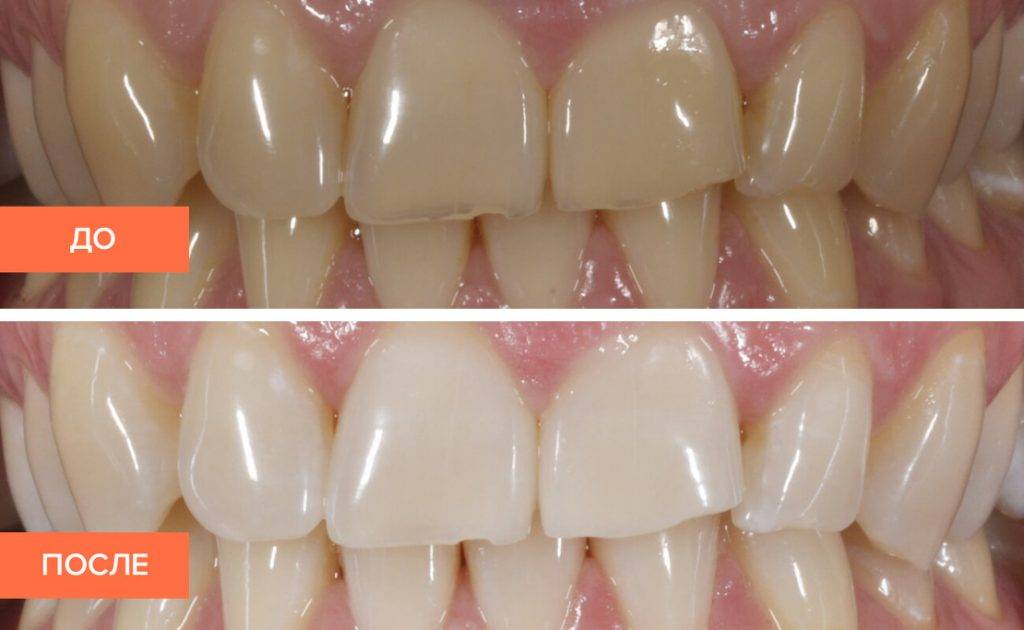 Фторлак для зубов | покрытие, фото до и после, цена, отзывы