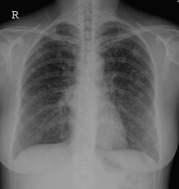 Что показывает рентгенография органов грудной клетки, и как к ней подготовиться?