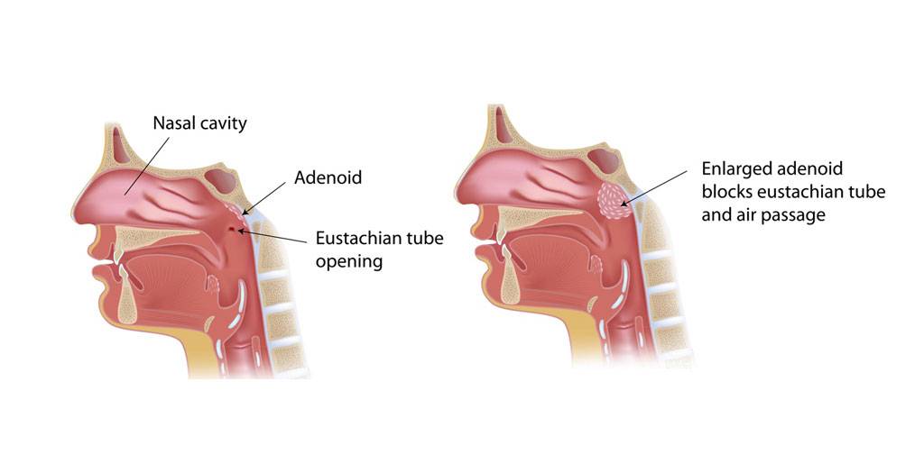 Заложенность уха при насморке: причины и лечение заложенности ушей и носа, как снять боли в горле