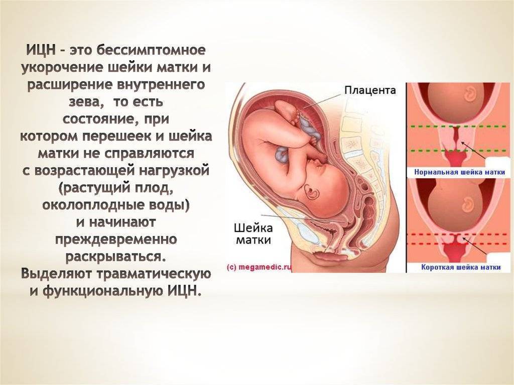 Каковы основные причины невынашивания беременности
