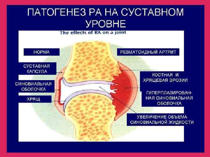Ювенильный артрит / заболевания и состояния /  клиника современной ревматологии