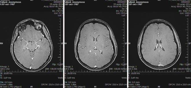 Киста сосудистого сплетения головного мозга: возникновение, диагностика, лечение