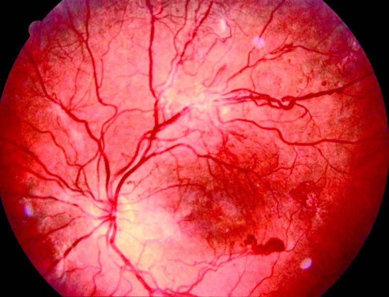 Диабетическая ретинопатия симптомы, лечение. офтальмологический портал vseozrenii.