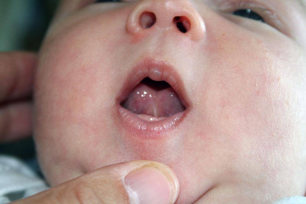 Мозоль на губе у новорожденного: почему появляется новообразование на верхней и нижней, последствия для ребенка, фото