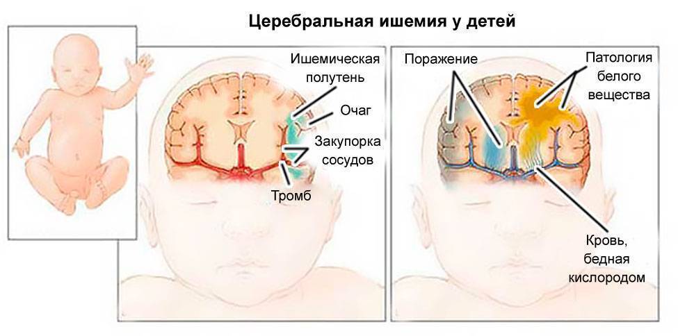 Ишемия головного мозга у новорожденных