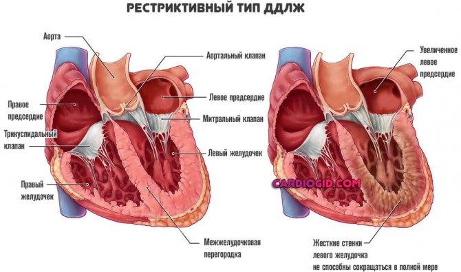 Дополнительная хорда в полости левого желудочка: что это, причины, виды, симптомы, лечение