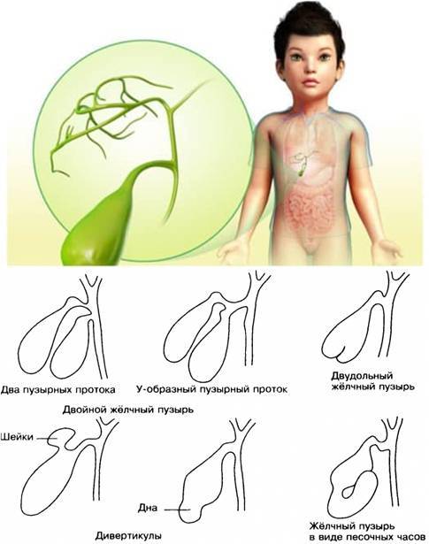 Загиб желчного пузыря у ребенка - симптомы и лечение