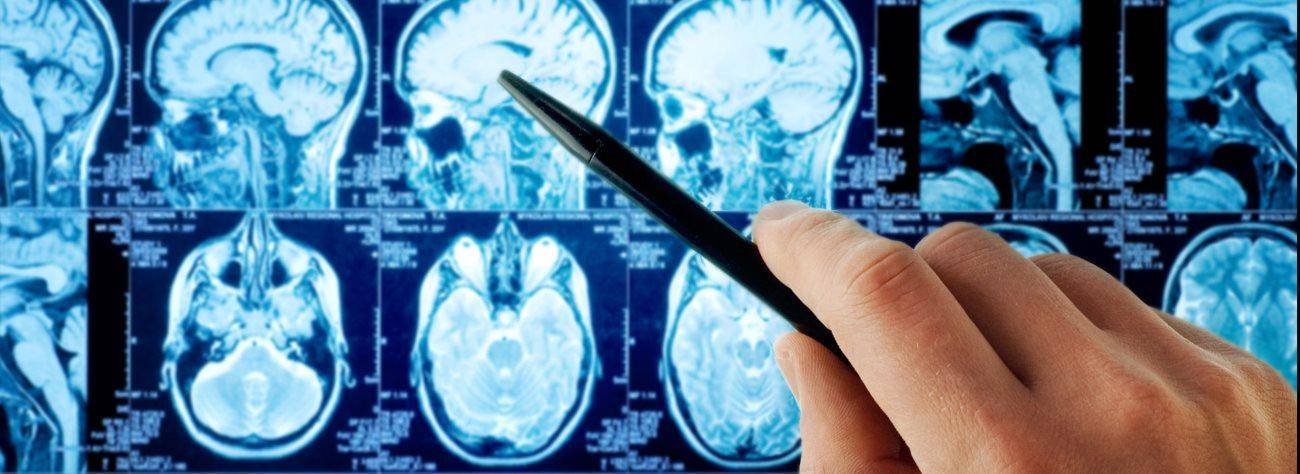 Злокачественная - не значит приговор. что мы знаем о раке головного мозга? | здоровье: медицина | здоровье | аиф тюмень