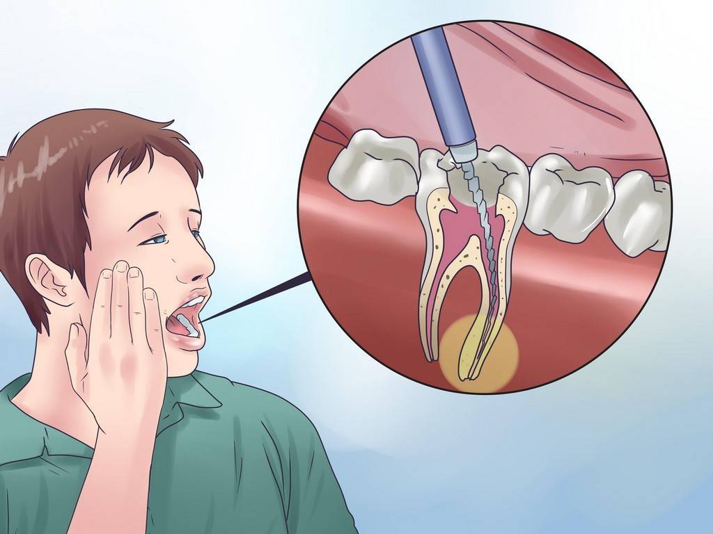 Зубная боль – чем снять или облегчить зубную боль в домашних условиях?