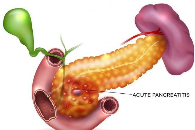 Хронический панкреатит у детей | компетентно о здоровье на ilive