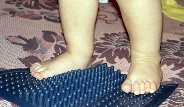Плоскостопие у детей: лечение и диагностика