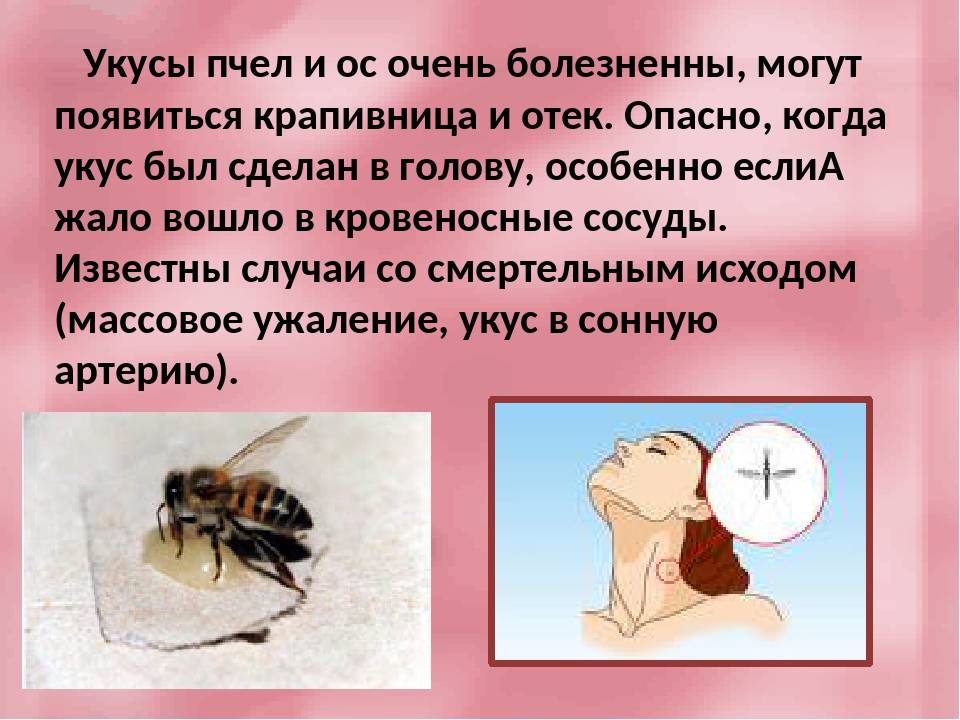 Оказание первой медицинской и доврачебной помощи при укусе пчелы осы
