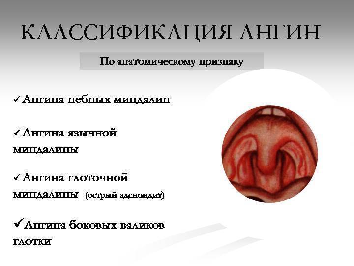 Современный метод лечения тонзиллита - прижигание миндалин
