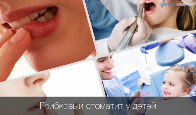 Стоматит у детей: виды и лечение | healthy dent (киев)