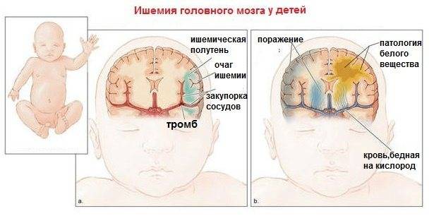 Ээг в детском возрасте – важное исследование работы коры головного мозга