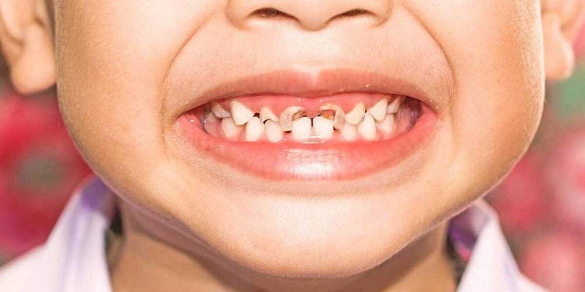 Причины пульпита молочного зуба у детей и лечение