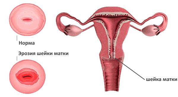 Менструация два раза в месяц: в чем причина
