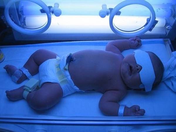 Лампа при желтухе новорожденных. ответы на ваши вопросы.