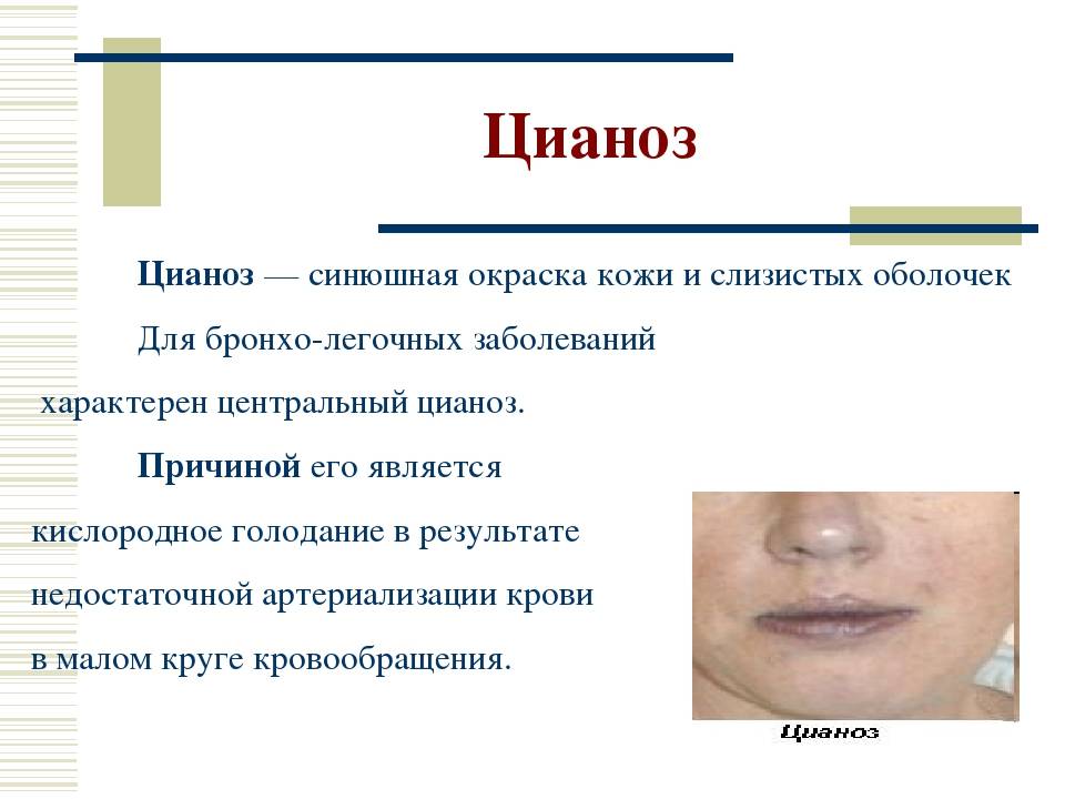Острая дыхательная недостаточность у детей: виды, степени и причины