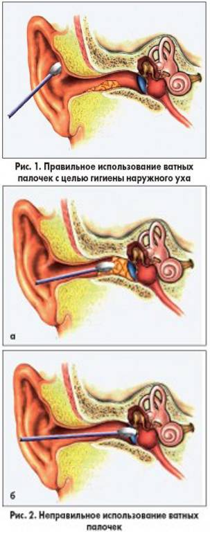 Если в ухи застряла вата. Серная пробка на барабанной перепонке.