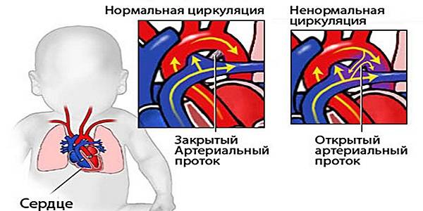 Открытое овальное окно в сердце у ребенка: 9 причин, 5 симптомов, чем опасно, лечение, последствия