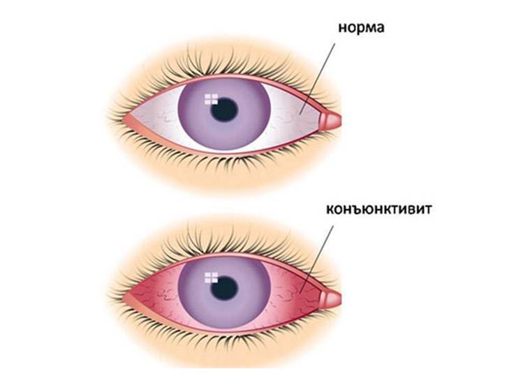 Конъюнктивит - причины, симптомы, лечение конъюнктивита. все глазные болезни - vseozrenii.
