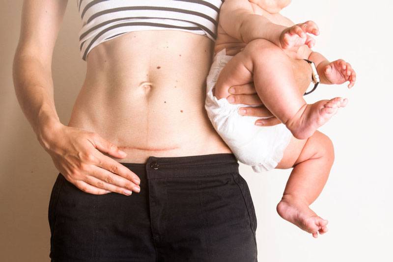 Опущение и выпадение матки: объяснение гинеколога