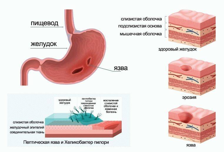 Симптомы и причины несварения желудка | полезные статьи креон
