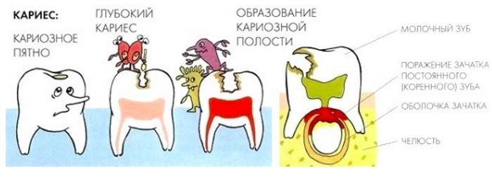 Кариес молочных зубов: причины возникновение, лечение, профилактика