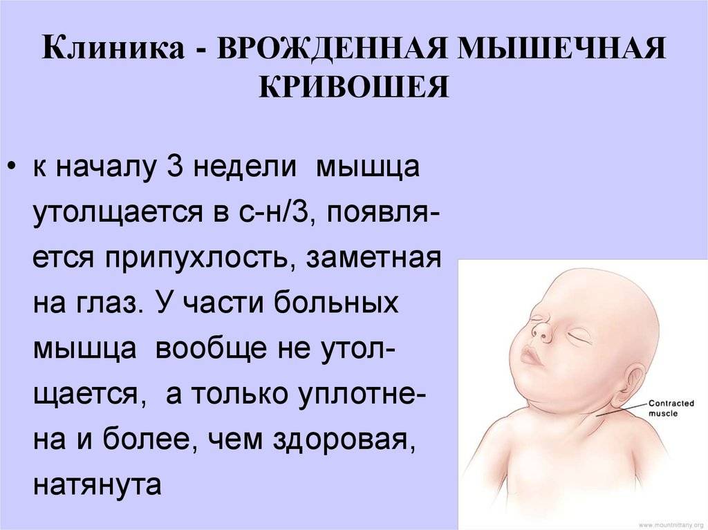 Кривошея у новорожденных