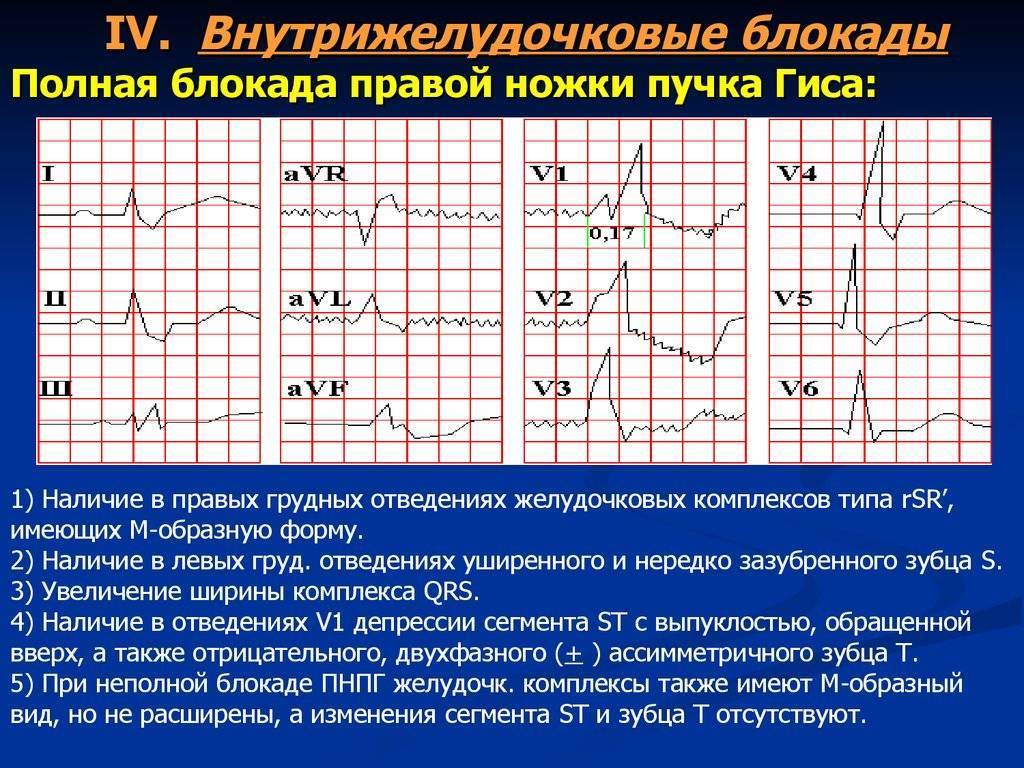 Нарушение внутрижелудочковой проводимости сердца классификация, причины, признаки, лечение